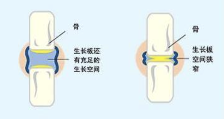 身高管理科普|骨骺线闭合了还能长高吗?家长们要时刻注意孩子的骨龄 - 深圳运世达心成诊所