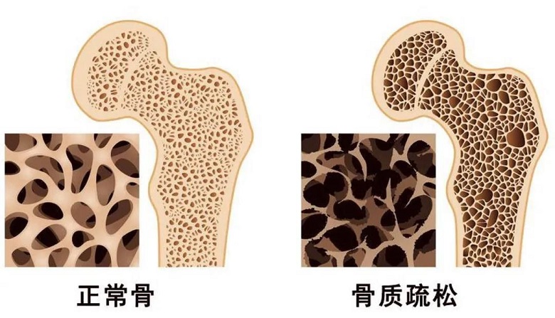 儿童身高管理|你家孩子的“骨密度”达标了吗？ 骨密度和身高有什么关系？- 深圳运世达心成诊所