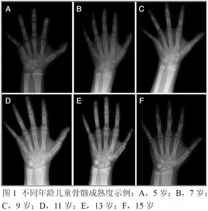 儿童身高管理|儿童长高治疗三步走：测骨龄、查激素、定方案 - 深圳运世达心成诊所