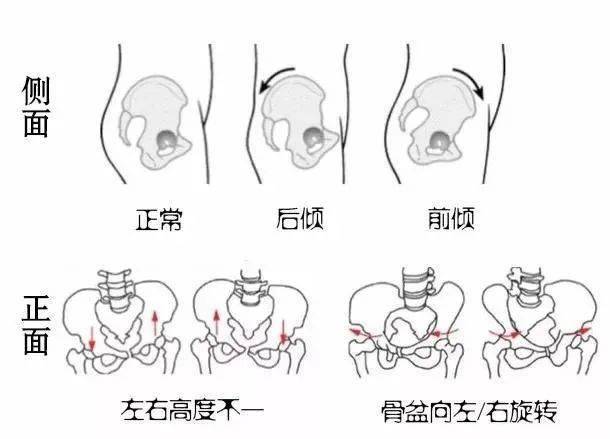 女性健康管理|女性骨盆歪斜会引发哪些问题？如何保护骨盆健康？- 深圳运世达心成诊所